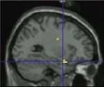 Amygdala