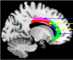 MRI image of the human brain and cingulate
