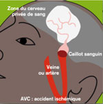 illustration of a stroke