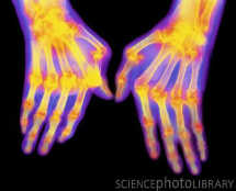 X-ray of hands with rheumatoid arthritis