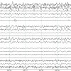 Figure 3b (click to enlarge).  Samples of EEG during reading (7 seconds) derived from Brodmann Laplacian montage and showing EEG characteristics in each anatomically defined region.  Note sharp waves, fast (beta) bursts and trains of slow activity in supplemental motor (including operculum) region in top 2 channels (as seen in Figure 3a).  This disturbance was seen in all states.