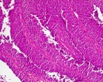 Urothelial_papillary_carcinoma_cancer