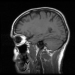 MRI