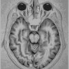 MRI