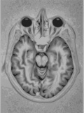 MRI