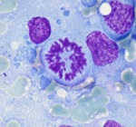 Lymphoma Cell