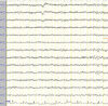 An EEG of a patient with panic disorder