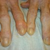 Hands of a person with osteoarthritis
