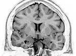 MRI of the human brain