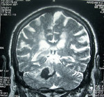 MRI of brain after a stroke
