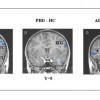 Brain Imaging Identifies Differences In Childhood Bipolar Disorder And ADHD MRI study