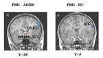 MRI of brains from two different mental disorders