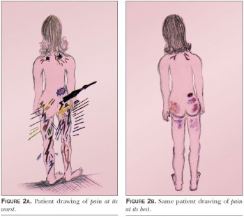 Figures 2a and 2b shows a drawing of pain intensity