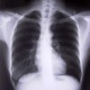 xray of the chest