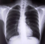 xray of the chest