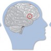 brainwave activity in individuals with dyslexia