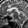 Pioneering Treatment Could Help People With Severe Depression MRI showing where deep brain stimulation occurred