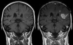 MRI of a stroke patient
