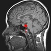 Integrity Of Brain Reward System Linked To Relapse After Subtance Abuse Treatment MRI of the brain