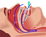 illustration of sleep apnea