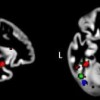 Researchers Explain Exceptional Visual Abilities In Autism Brain images of spacial distribution