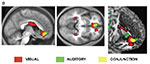 neuroimages of the brain