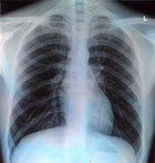 chest xray