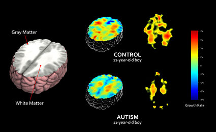 Autistic Brains Develop More Slowly Than Healthy Brains Bmed Report