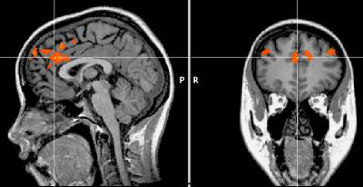 MRI of the brain during low patience